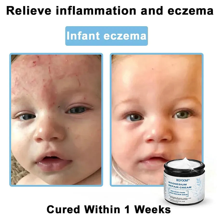 BQYOOM™ Magnesium skin repair cream👨‍⚕️NHS Approved (Psoriasis and Eczema Relief, Skin Repair, Even Tone, Acne and Dark Spot Treatment, Wart and Mole Removal)