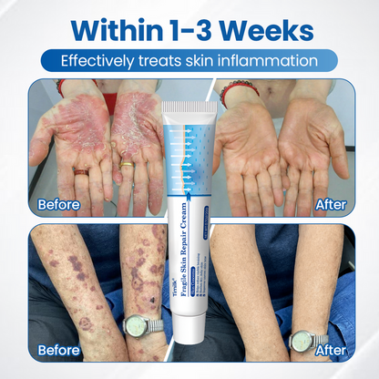 Timilk® Fragile Skin Repair Cream🛡️🌿 Multi-Repair for Bruises, Dryness & Spots
