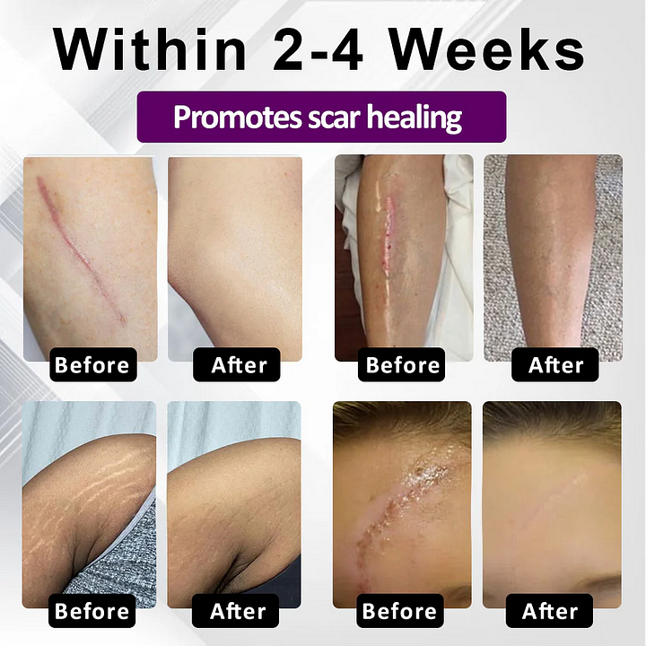 BQYOOM™ SiluSkin Advanced Face & Body Scar Gel🎉SPECIAL OFFER: 60% OFF This Today Only!🔥