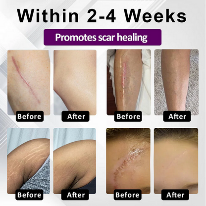 BQYOOM™ SiluSkin Advanced Face & Body Scar Gel🎉SPECIAL OFFER: 60% OFF This Today Only!🔥
