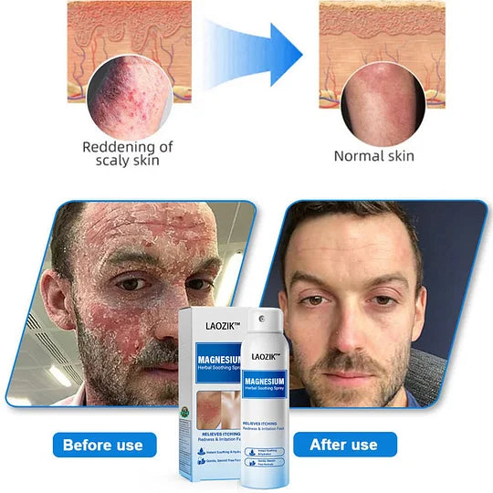 🔥Final 3 Hours: 80% OFF -LAOZIK™ Magnesium Herbal Soothing Spray