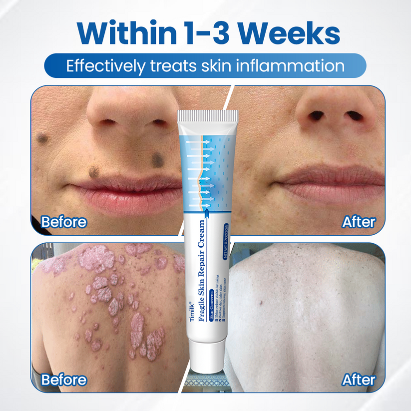Timilk® Fragile Skin Repair Cream🛡️🌿 Multi-Repair for Bruises, Dryness & Spots
