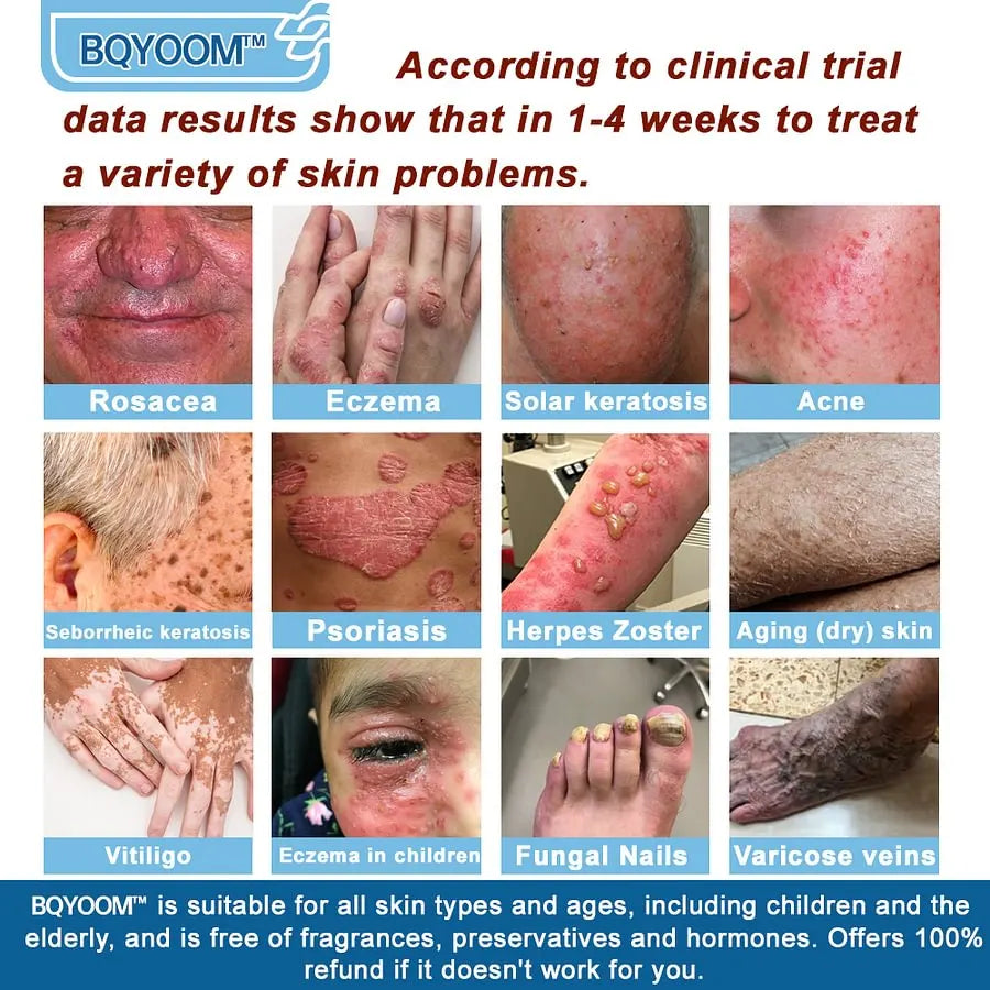 BQYOOM™ Magnesium skin repair cream👨‍⚕️NHS Approved (Psoriasis and Eczema Relief, Skin Repair, Even Tone, Acne and Dark Spot Treatment, Wart and Mole Removal)