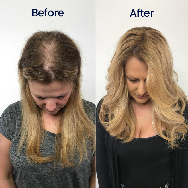 Biancat® Maximum Strength 5% Minoxidil Fast-Action Hair Growth Serum🎉SPECIAL OFFER: 60% OFF This Today Only!🔥