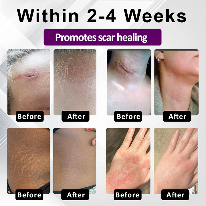 BQYOOM™ SiluSkin Advanced Face & Body Scar Gel🎉SPECIAL OFFER: 60% OFF This Today Only!🔥