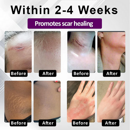 BQYOOM™ SiluSkin Advanced Face & Body Scar Gel🎉SPECIAL OFFER: 60% OFF This Today Only!🔥