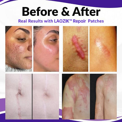 Official Store: LAOZIK™ Repair Microneedles Pro Patches with Hyaluronic Acid Nano-Heal Treatment for new and old scars, reduction of surgical scars, stretch marks, keloids, acne, burns, warts, dermatomas, and varicose veins