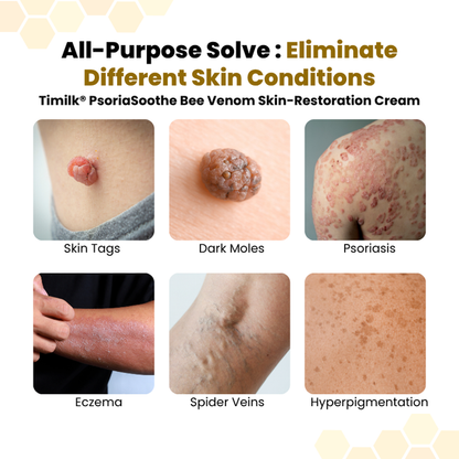 💥Timilk® PsoriaSoothe Bee Venom Skin-Restoration Cream⏳Limited-time 49% off⏰💥