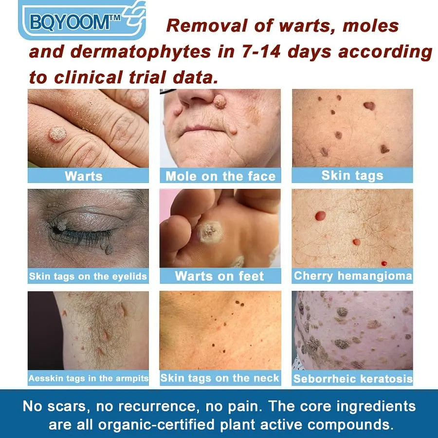 BQYOOM™ Magnesium skin repair cream👨‍⚕️NHS Approved (Psoriasis and Eczema Relief, Skin Repair, Even Tone, Acne and Dark Spot Treatment, Wart and Mole Removal)
