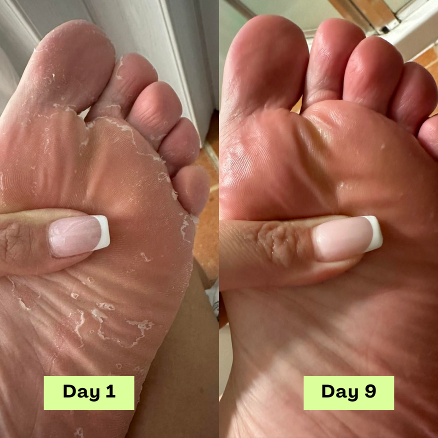 FungiFree® AntiFungal Relief Soap Bars🔥🔥🔥