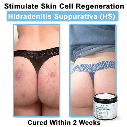 BQYOOM™ Magnesium skin repair cream👨‍⚕️NHS Approved (Psoriasis and Eczema Relief, Skin Repair, Even Tone, Acne and Dark Spot Treatment, Wart and Mole Removal)