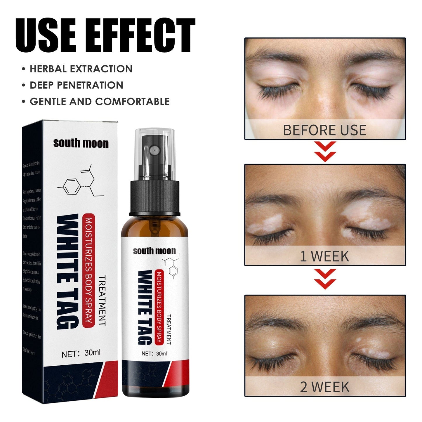 Vitiligo Relief Spray