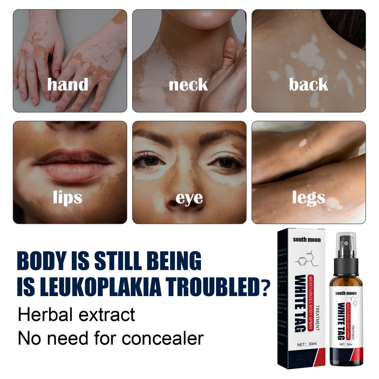 Vitiligo Relief Spray